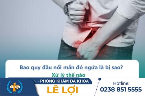 Bao quy đầu tại sao lại nổi mẩn đỏ – Làm gì để hết nổi mẩn