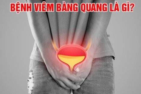 Viêm bàng quang là bệnh gì – điều trị hiệu quả tại Phòng khám Việt Hải