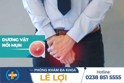 Mụn dương vật: Nguyên nhân và cách điều trị hiệu quả