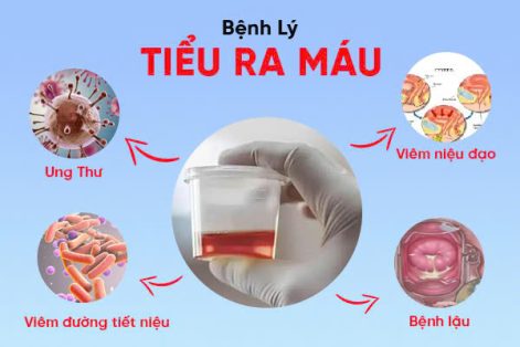 Vì sao nước tiểu màu đỏ? Nguyên nhân thường gặp và cách xử lý