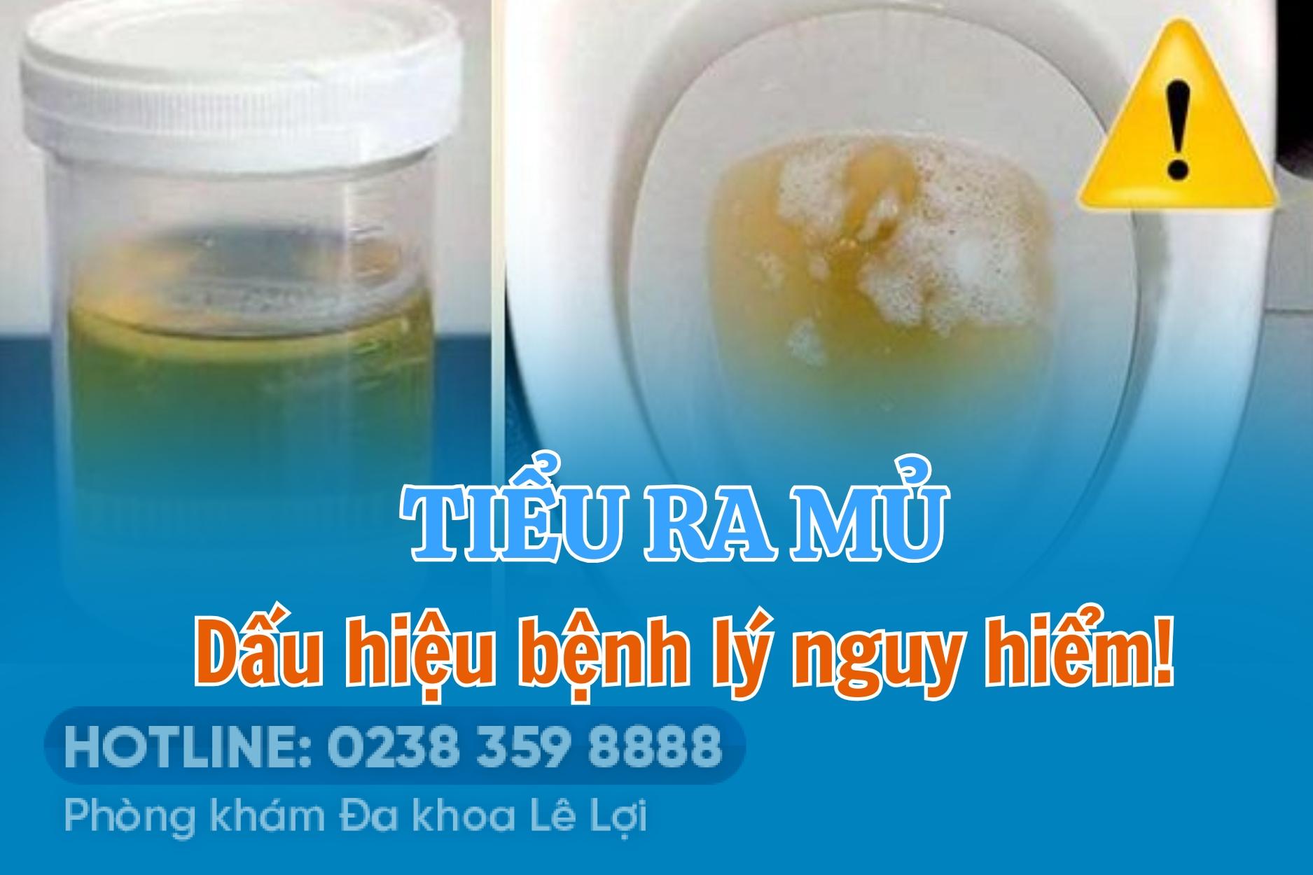 Tiểu ra mủ ở nam – dấu hiệu bệnh lý nguy hiểm cần phát hiện sớm
